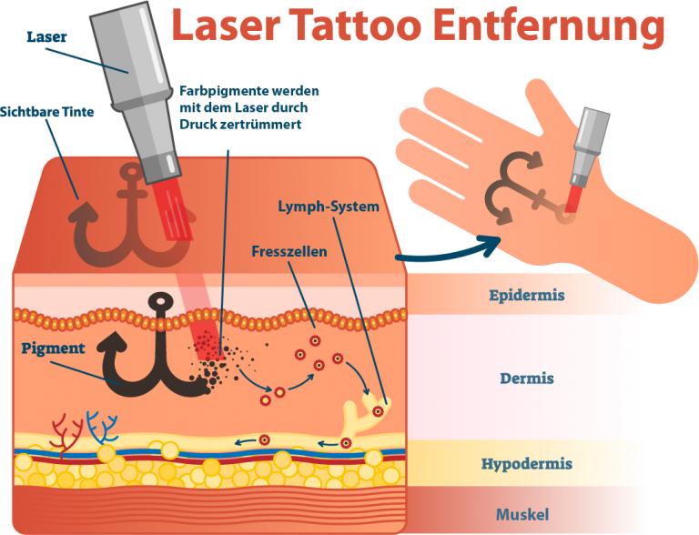 Wie funktioniert eine Laser Tattoo Entfernung